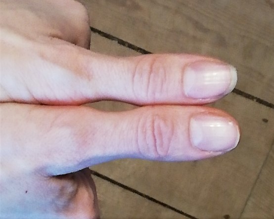 Thumbs used to measure fats portion size